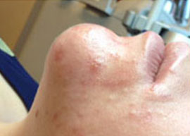 Hydrafacial_Oelige-Haut