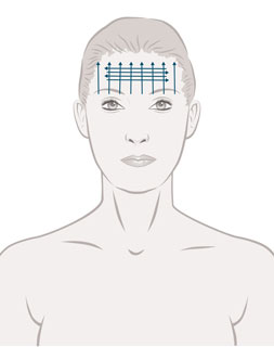Fadenlifting_Cosmedicpoint_Gratkorn_Stirnlift